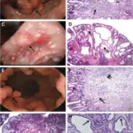 Gastric Polyps