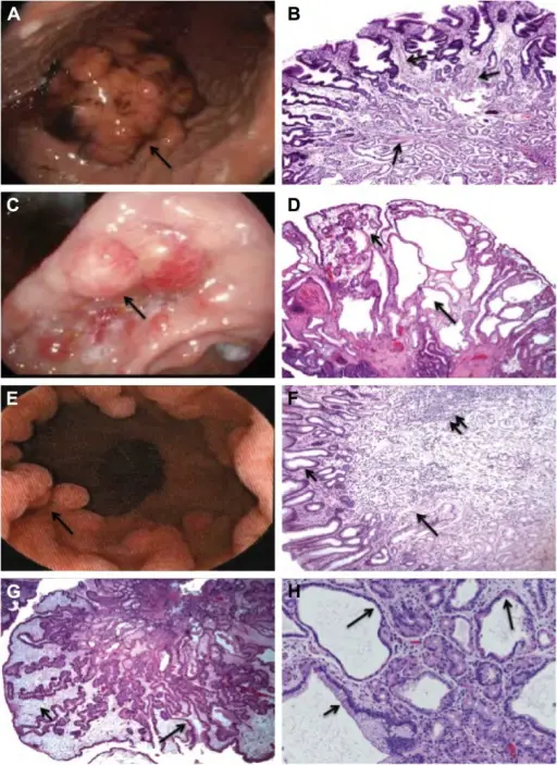 Gastric Polyps