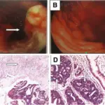 Gastric Tumors