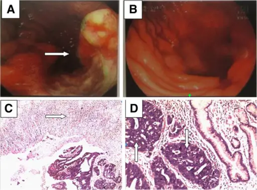 Gastric Tumors