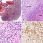 Gastrointestinal Stromal Tumor