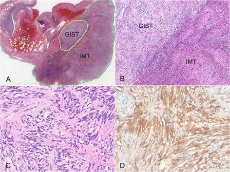 Gastrointestinal Stromal Tumor