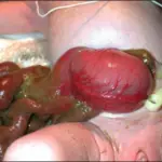 Gastroschisis