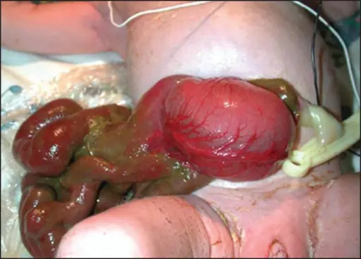 Gastroschisis