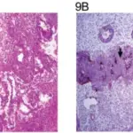 Germ Cell Tumors