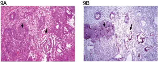 Germ Cell Tumors