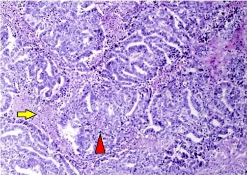 Germ Cell Tumors of the Ovary