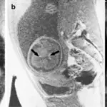 Germinal Matrix Hemorrhage