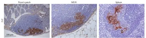 Gerstman-Straussler-Scheinker Syndrome