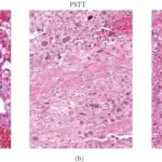 Gestational Trophoblastic Diseases