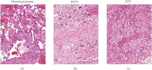 Gestational Trophoblastic Diseases