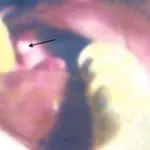 Gingival Cyst of a Newborn