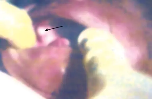 Gingival Cyst of a Newborn