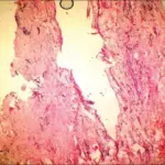 Gingival Cyst of an Adult