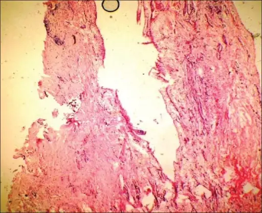 Gingival Cyst of an Adult