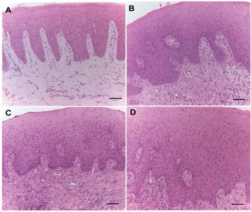 Gingivitis