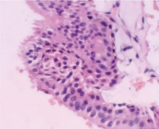 Glandular Odontogenic Cyst