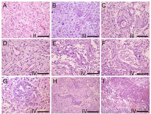 Gliomas