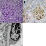 Glomerular Diseases