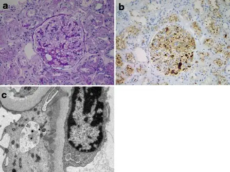 Glomerular Diseases