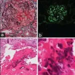 Glomerulonephritis Associated with Bacterial Endocarditis