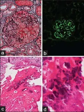 Glomerulonephritis Associated with Bacterial Endocarditis