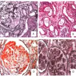 Glomerulonephritis Associated with Systemic Infections