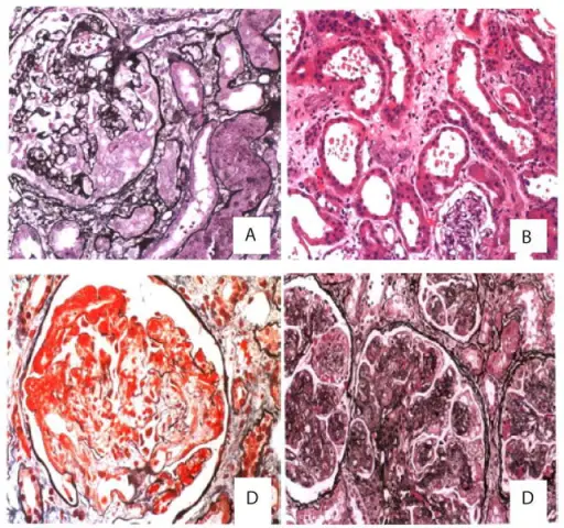 Glomerulonephritis Associated with Systemic Infections