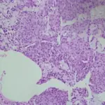 Glomus Tumor