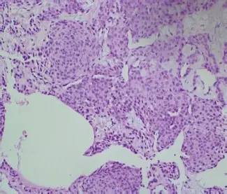 Glomus Tumor