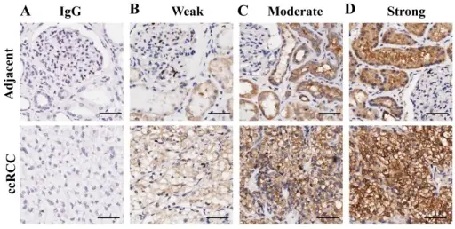 Glucose-6-Phosphate Dehydrogenase Deficiency