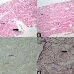 Glycogen Storage Diseases