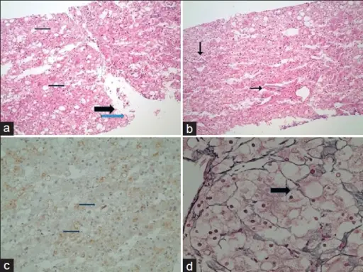 Glycogen Storage Diseases