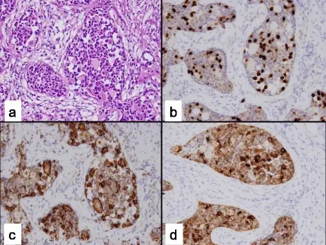 Gonadoblastoma