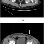 Gonococcal Urethritis