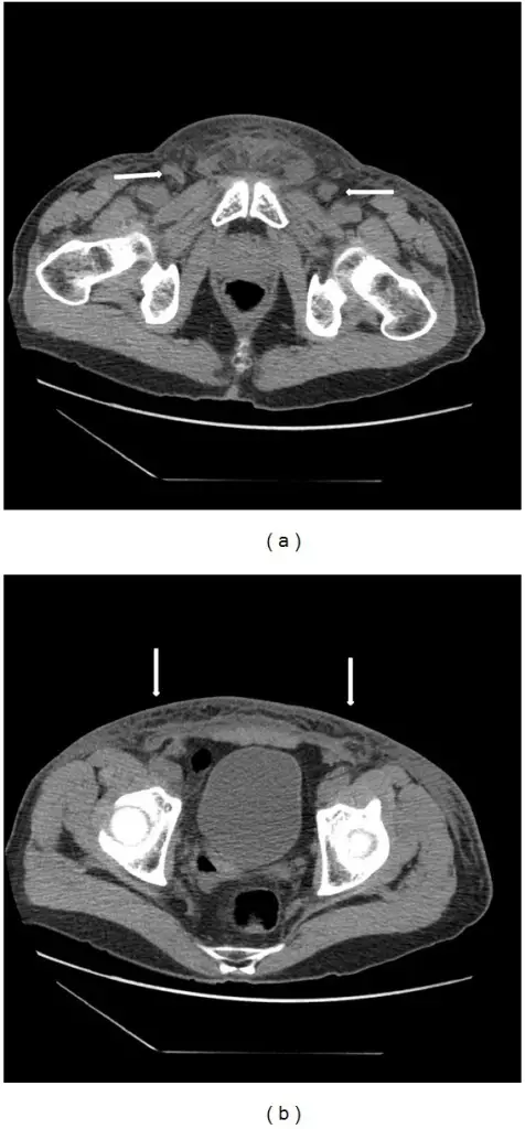 Gonococcal Urethritis