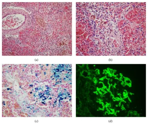 Goodpasture Syndrome