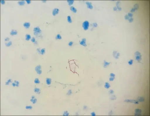 Gram-Positive Bacterial Infections