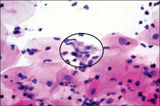 Granuloma Inguinale