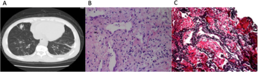 Granulomatosis with Polyangiitis