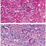 Granulomatosis with Polyangiitis