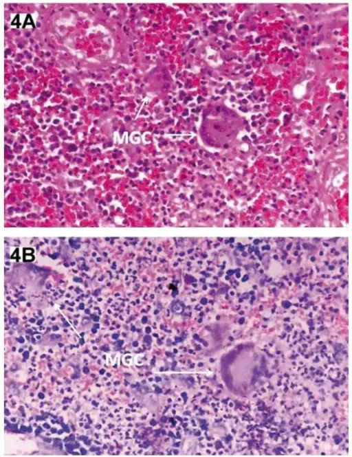 Granulomatosis with Polyangiitis