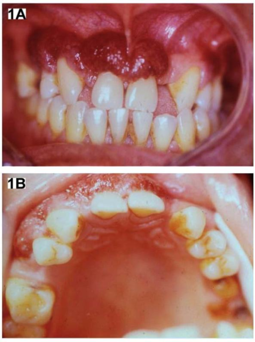 Granulomatosis with Polyangiitis