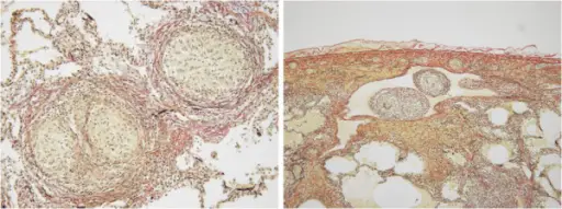 Granulomatous Diseases That Cause Restrictive Lung Diseases