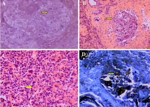 Granulomatous Prostatitis