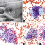 Granulomatous Thyroiditis