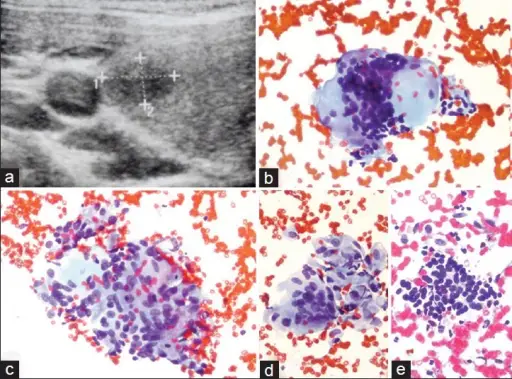 Granulomatous Thyroiditis