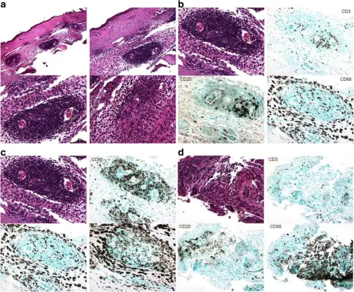 Granulomatous with Polyangiitis