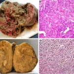 Granulosa Cell Tumors