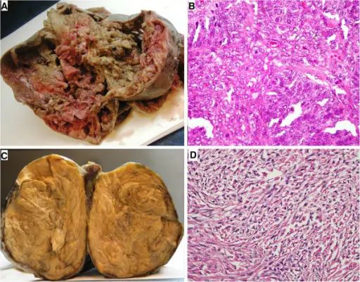 Granulosa Cell Tumors